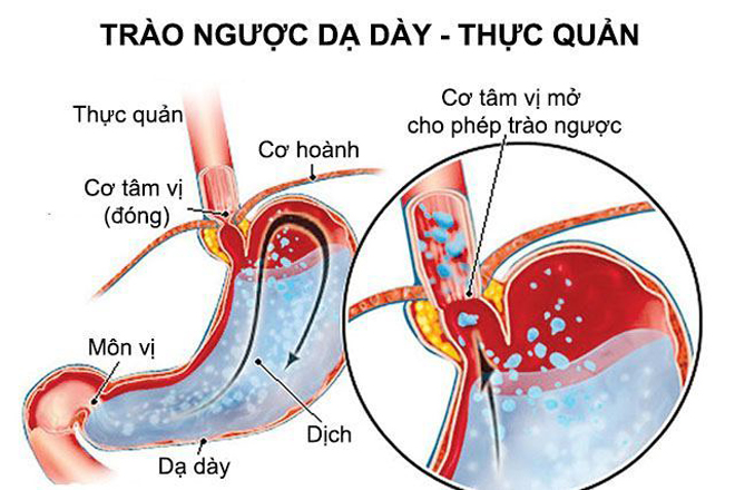 Shortness of breath, shortness of breath - warning signs of worsening reflux - 2