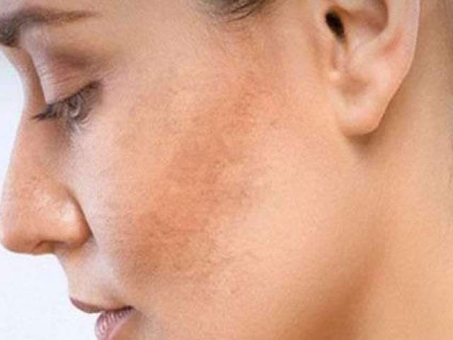 Làm đẹp - Chữa sạm da bằng 7 biện pháp tự nhiên, sẵn có