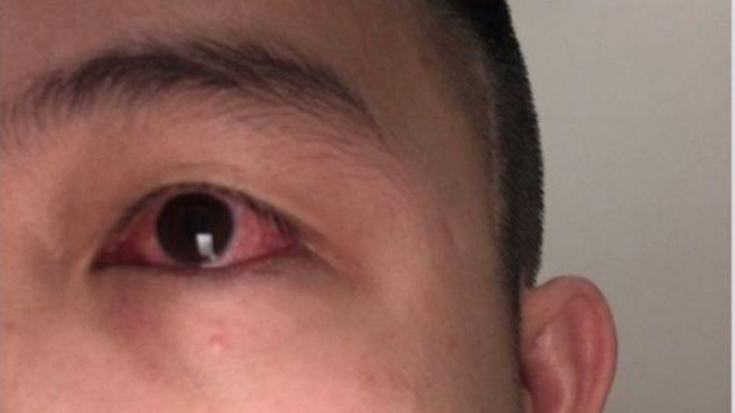 Người bị đau mắt có thể rửa hoặc xông mắt bằng nước lá trầu không.