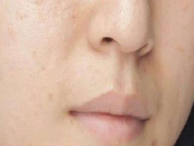 Làm đẹp - 5 biện pháp khắc phục tại nhà cho da bị mụn