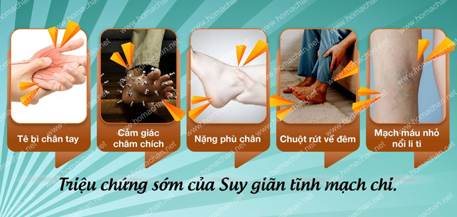 Triệu chứng của suy giãn tĩnh mạch chi