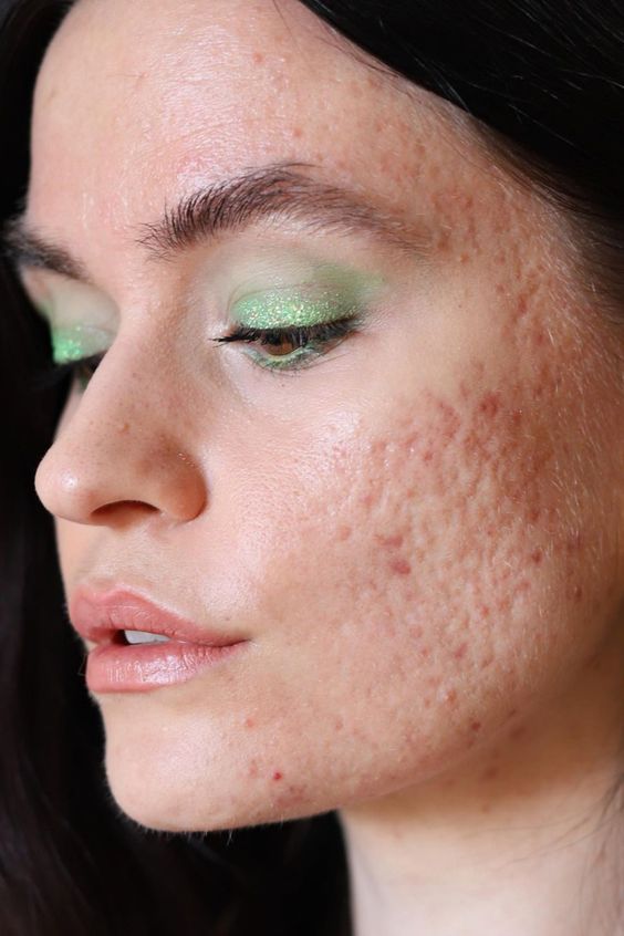 Có một số quy trình trị sẹo mụn như lột da bằng hóa chất, điều trị bằng laser và mài da.