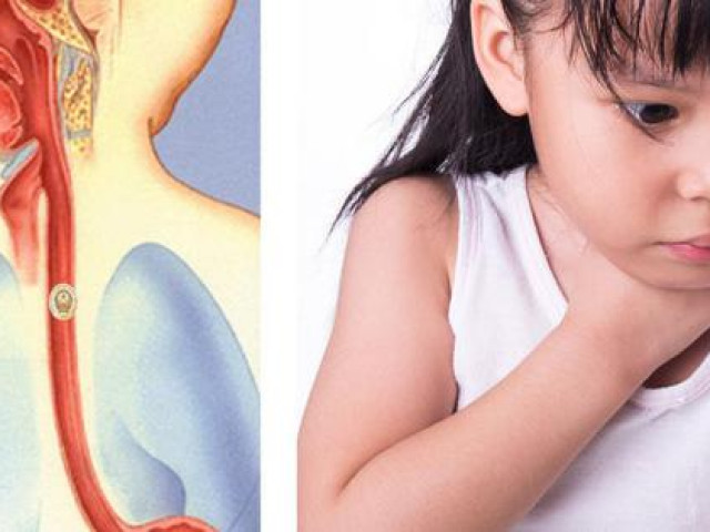 Chuyên gia tai mũi họng cảnh báo thói quen ăn uống dễ gặp dị vật đường ăn