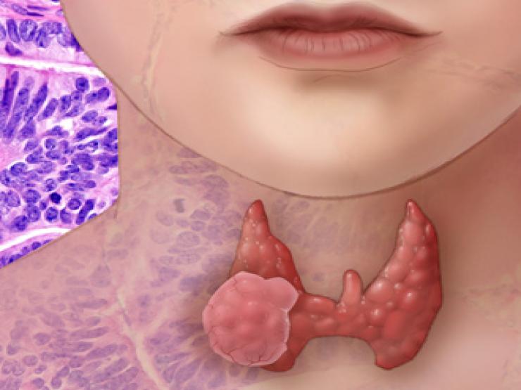 Sức khỏe đời sống - Dấu hiệu nhận biết ung thư tuyến giáp trẻ em