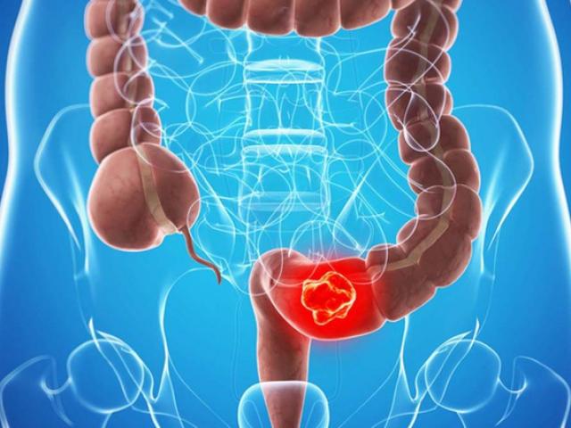 Người Việt mắc và tử vong do ung thư đại trực tràng ngày càng nhiều vì những thói quen này