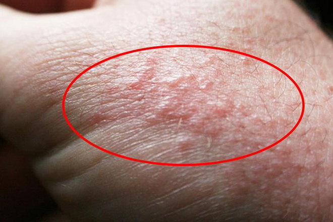 Tay chân nổi mụn nước "ngứa như điên" gãi chán tay không hết, thử ngay cách này liền ổn! - 2