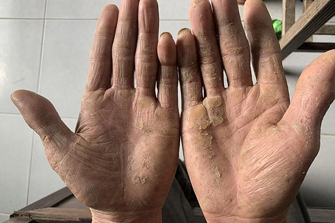 Tay chân nổi mụn nước "ngứa như điên" gãi chán tay không hết, thử ngay cách này liền ổn! - 3