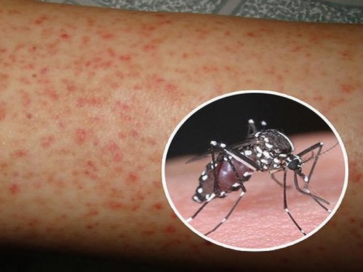 Sức khỏe đời sống - Đã có 77.000 ca mắc sốt xuất huyết, 30 ca tử vong