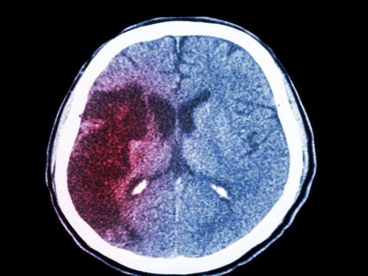 Sức khỏe đời sống - Xuất huyết não “giết người nhanh nhất”, 4 dấu hiệu trước khi khởi phát nhưng dễ bị bỏ qua