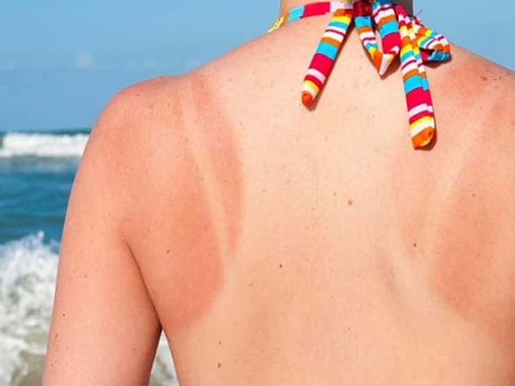 Làm đẹp - 6 cách chữa cháy cho da hiệu quả tức thì