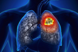 Quan điểm “đã mắc ung thư phổi là nhận bản án tử”: Đúng hay sai?