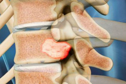 Sức khỏe đời sống - Cơ thể thường xuyên xuất hiện 5 triệu chứng này, rất có thể u tủy đang ghé thăm