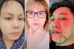 Bị liệt cơ mặt giống Hari Won, Việt Hương: Nam MC tiết lộ sự nguy hiểm của bệnh