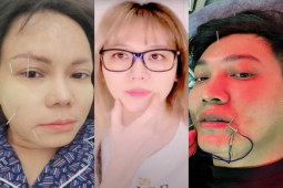 Bị liệt cơ mặt giống Hari Won, Việt Hương: Nam MC tiết lộ sự nguy hiểm của bệnh