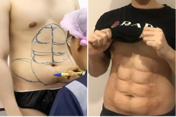 Đàn ông - Bỏ 328 triệu phẫu thuật "khắc bụng" chuẩn 6 múi, người đàn ông nhận cái kết đầy vật vã