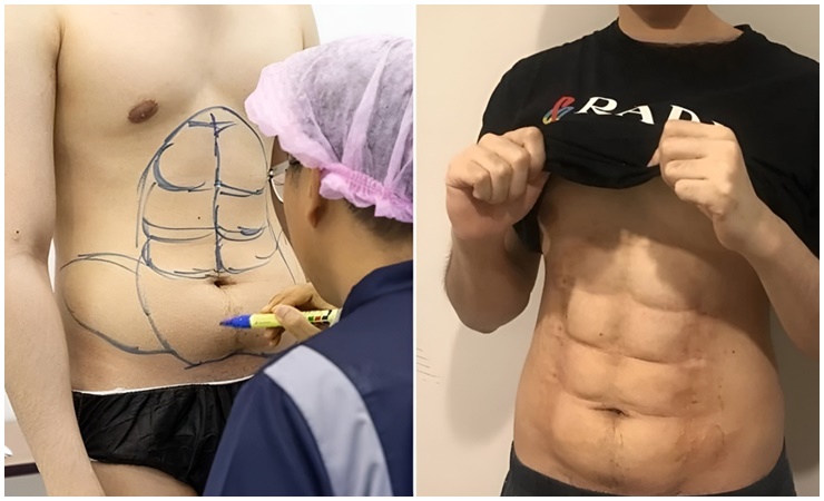 Nhà tạo mẫu tóc quyết tâm đi phẫu thuật thẩm mỹ để có cơ bụng chuẩn 6 múi.