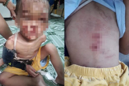 Cha mẹ ruột trong vụ bé trai bị bạo hành âm tính với ma túy