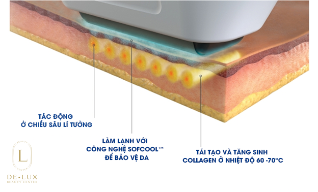 Công nghệ Sofwave được FDA chứng nhận xoá nhăn và nâng cơ - 2