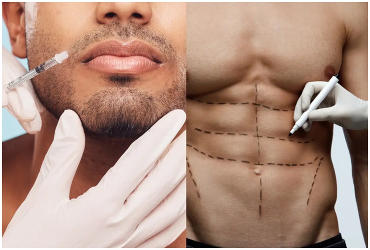 Hút mỡ bụng để tạo cơ và hút mỡ má để có gương mặt góc cạnh được nam giới ưa chuộng.