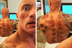 Sức khỏe đời sống - Liệu pháp có từ thời cổ đại khiến cả The Rock, Lady Gaga và nhiều siêu sao tìm tới chữa trị