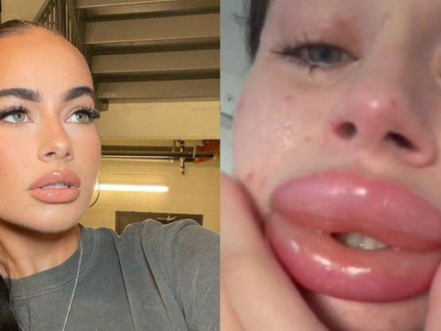 Bạn trẻ - Cuộc sống - Đôi môi như mỏ vịt của cô gái tiêm filler miễn phí