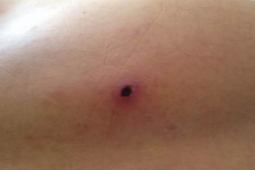 Sức khỏe đời sống - Sau 2 tuần đi du lịch, nam thanh niên 18 tuổi bị loét vùng bìu