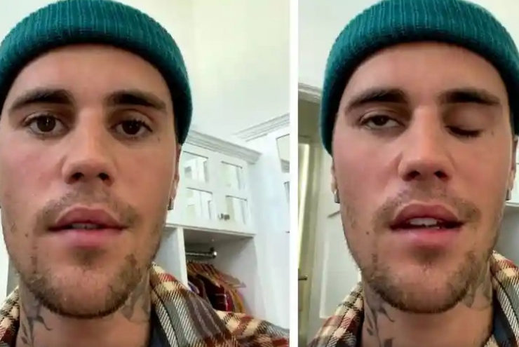 Hội chứng bệnh tưởng lạ mà quen khiến Justin Bieber bị liệt nửa mặt