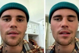 Hội chứng bệnh tưởng lạ mà quen khiến Justin Bieber bị liệt nửa mặt