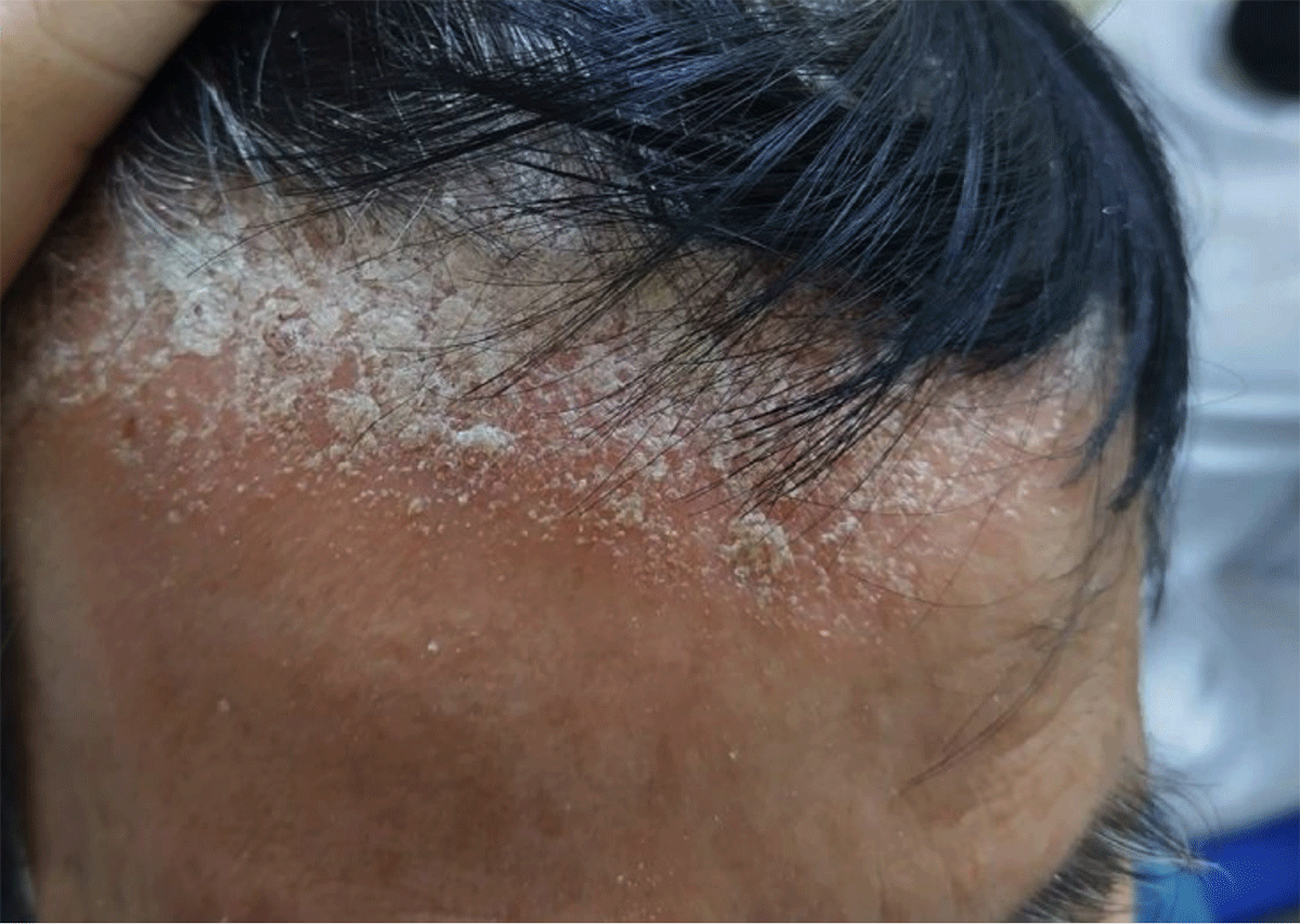 Nếu đầu có nhiều gàu, bạn nên chọn cho mình loại dầu gội trị gàu chuyên biệt