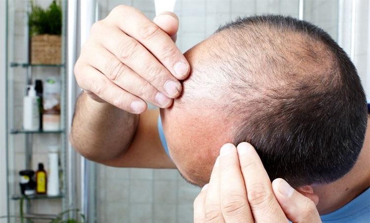 Dùng sai dầu gội có thể khiến tóc rụng nhiều, hói đầu