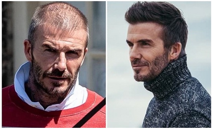 David Beckham bị hói đầu.