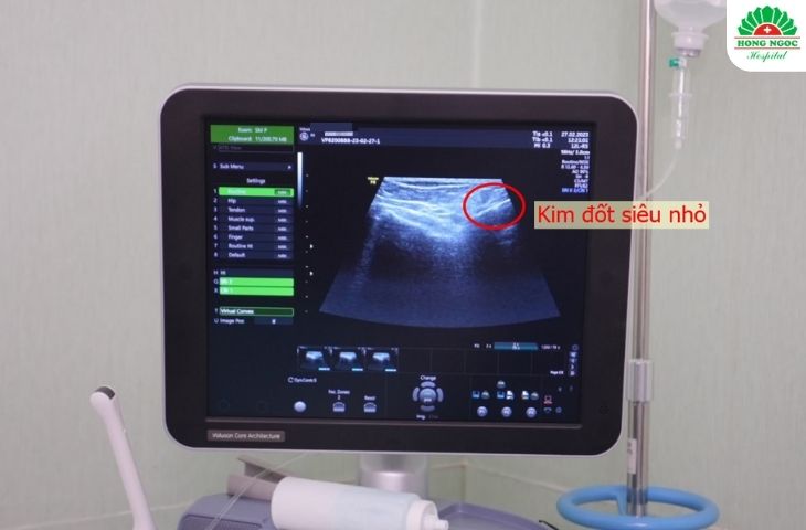 Máy siêu âm rõ nét, đầu kim thông minh đốt chính xác dây thần kinh gây đau