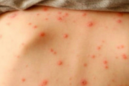 Sức khỏe đời sống - Dấu hiệu nhận biết bệnh thủy đậu ở trẻ