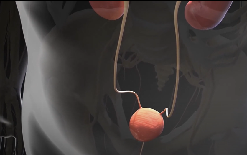 Bàng quang tăng hoạt OAB là tình trạng bàng quang co bóp liên tục và đột ngột ngay cả khi nước tiểu chưa đổ đầy.