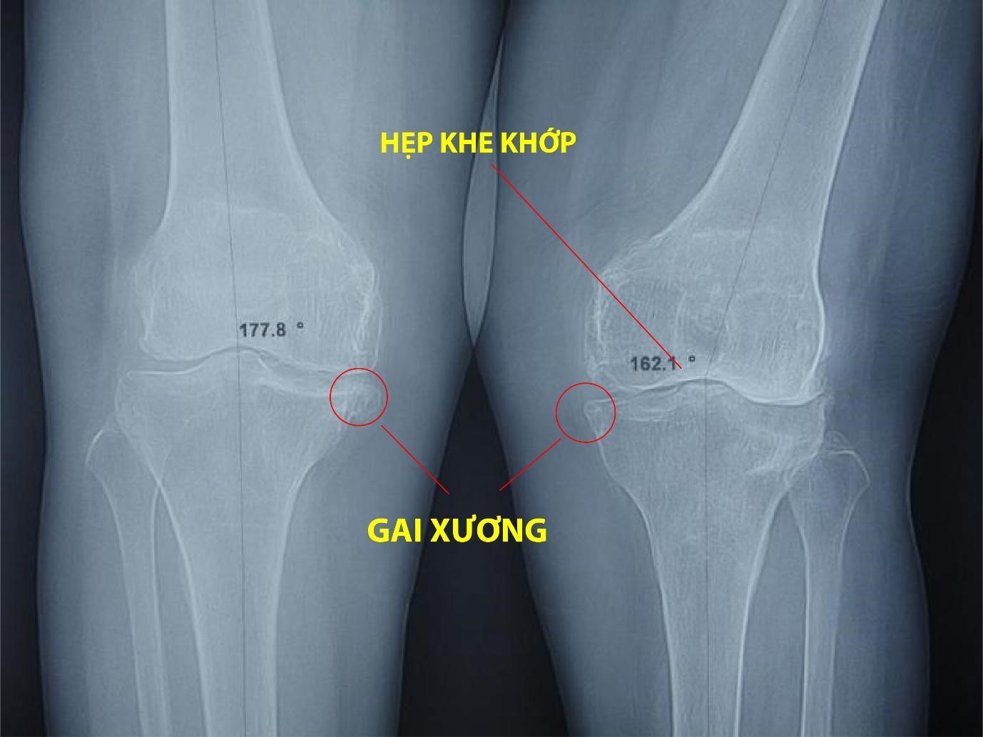 Thoát đau nhức gối “hành hạ” suốt 10 năm, cõng được cháu 15kg đi học nhờ cách này - 1