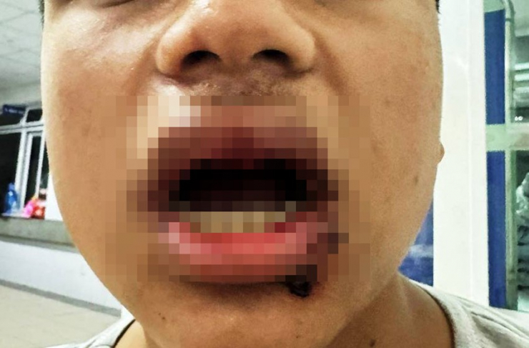 Nam sinh bị gãy 4 cái răng và đa chấn thương khác sau khi bị hành hung. Ảnh: Người thân cung cấp