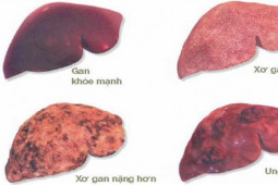 Những người nào dễ mắc ung thư gan, cần đi khám sớm?