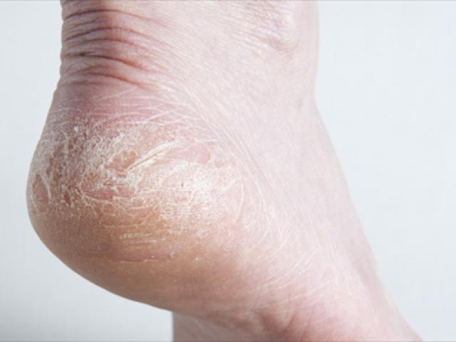 4 dấu hiệu ở bàn tay, bàn chân cảnh báo bệnh ung thư gan