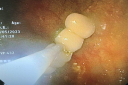 Sức khỏe đời sống - 4 chiếc răng giả “lạc trôi” vào dạ dày người phụ nữ