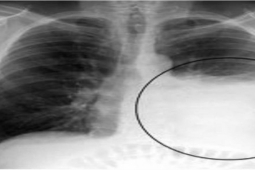 Sức khỏe đời sống - Phổi chàng trai 18 tuổi "nổ tung"? Kỳ thi tuyển sinh đại học đang đến gần, các sĩ tử cần chú ý