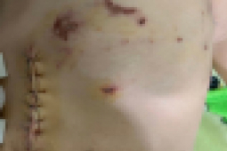 Tin tức trong ngày - Chó nuôi cắn thủng bụng bé 4 tuổi ở An Giang