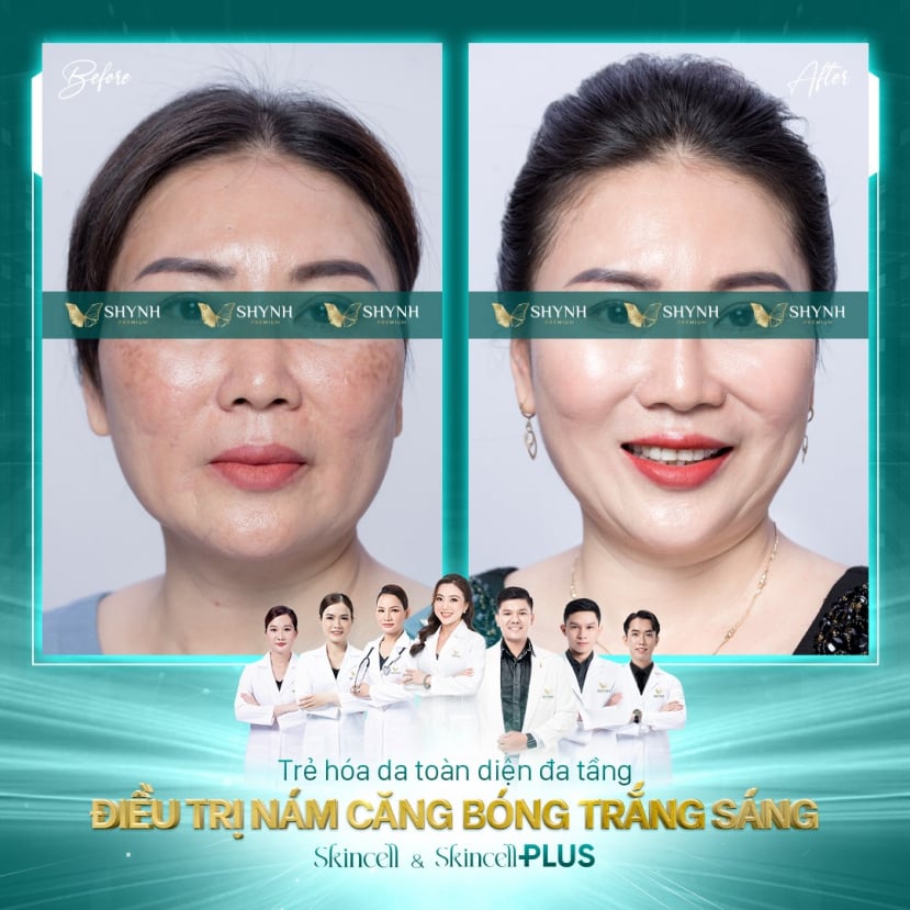 Khách hàng điều trị nám thành công tại Shynh Premium