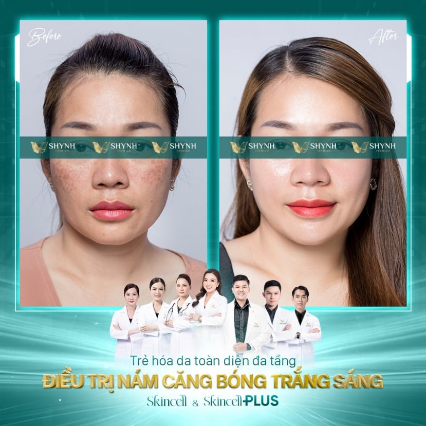 Ra mắt phác đồ điều trị nám Skincell & Skincell Plus by Shynh Premium - 3