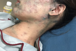 Sức khỏe đời sống - Mang thai 22 tuần phải nhập viện do tự ý dùng thuốc trị thuỷ đậu