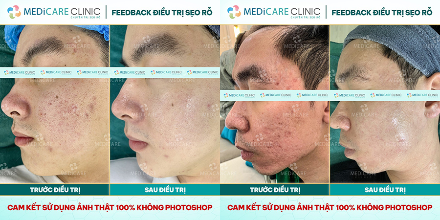 Feedback khách hàng sau liệu trình điều trị bằng phương pháp 5in1 tại Medicare Clinic