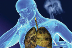 Bác sĩ Bệnh viện K cảnh báo dấu hiệu cảnh báo ung thư phổi