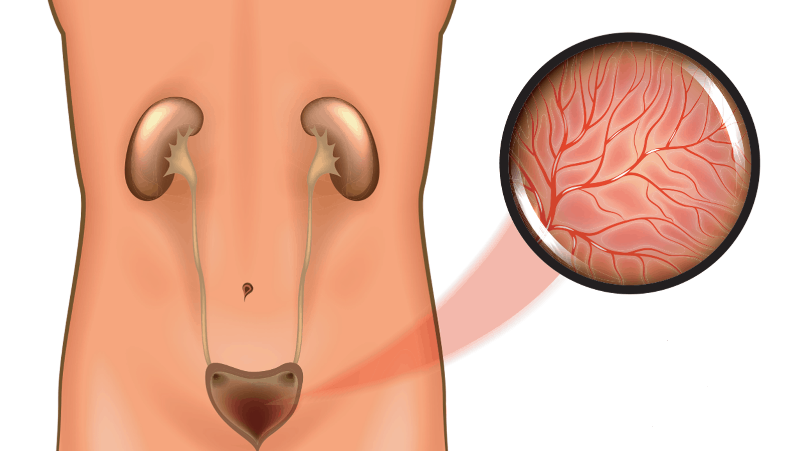 Bàng quang tăng hoạt OAB có thể gặp ở cả nam giới và phụ nữ