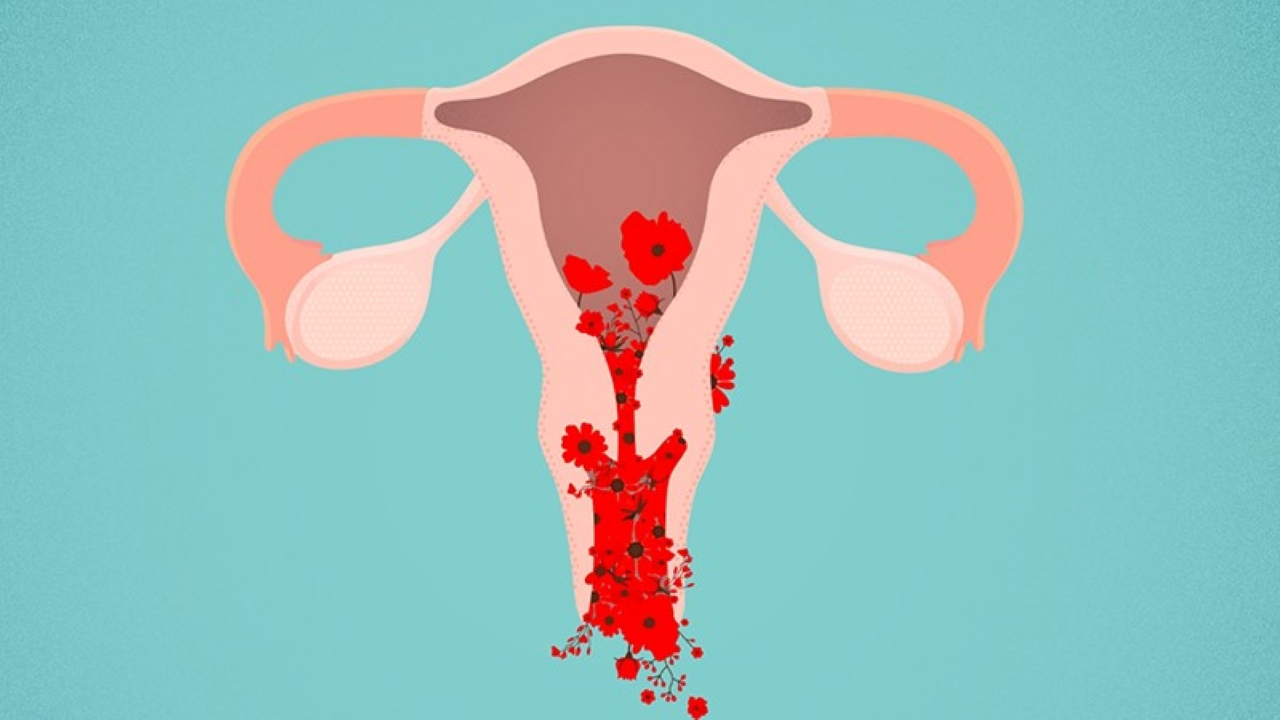 U xơ tử cung có thể gây tình trạng rong kinh kéo dài