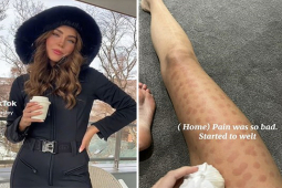 Bạn trẻ - Cuộc sống - Cô gái gặp “ác mộng” nhớ đời khi tẩy lông bằng laser