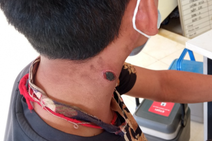 Một bệnh nhân mắc bệnh than tại tỉnh Điện Biên. Ảnh: CDC Điện Biên cung cấp